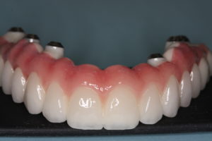 dantų implantai 