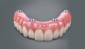 All on 4 Visi dantys ant keturių dantų implantų